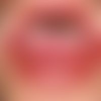 Stevens-Johnson-Syndrom:&nbsp; akut aufgetretene, großflächige, schmerzhafte Erosionen an Lippenr...