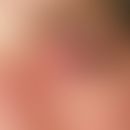 Stevens-Johnson-Syndrom: schwere, schmerzhafte mit erheblicher Lichtscheu einhergehende, purulent...