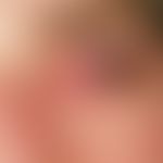 Stevens-Johnson-Syndrom: schwere, schmerzhafte mit erheblicher Lichtscheu einhergehende, purulent...