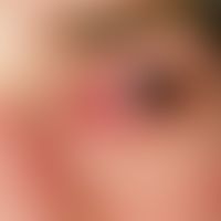 Stevens-Johnson-Syndrom: schwere, schmerzhafte mit erheblicher Lichtscheu einhergehende, purulent...