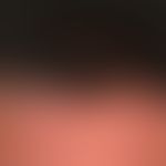 Psoriasis capitis: diffuse reddening of the entire capillitium with coarse lamellar scaling. Here...