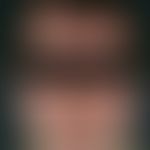 psoriasis capitis. 44-year-old man. chronically inpatient, intermittently increasing, extensive, ...