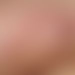 Folliculitis profunda. acute, solitary, since 1 week existing, moderately sharply definable, firm...