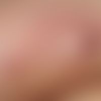 Folliculitis profunda. acute, solitary, since 1 week existing, moderately sharply definable, firm...