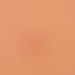 Folliculitis (superficial folliculitis): 0.5 cm large, inflammatory, non-purulent follicular papu...
