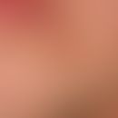 Follikulitis (superfizielle Follikulitis): 33 Jahre alter Mann; immer wieder auftretende, einzeln...