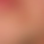 Folliculitis (superficial folliculitis): 33-year-old man; recurrent, single inflammatory follicul...