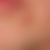 Folliculitis (superficial folliculitis): 33-year-old man; recurrent, single inflammatory follicul...