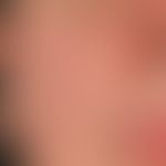 folliculitis (superficial folliculitis): single follicular inflammatory papules (so-called pimple...