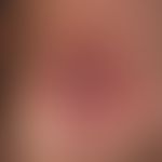 Keratoakanthoma, classic type. short term, within 6-8 weeks grown, approx. 2.5 cm diameter, hard,...