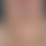 Madelung-Fatthals: for years increasing fatness of the neck region.
