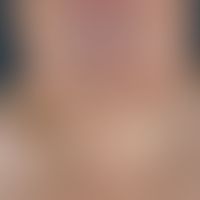 Madelung-Fatthals: for years increasing fatness of the neck region.
