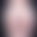 Lipomatosis benige symmetrical gynaecological type: disproportionate distribution of fatty tissue...