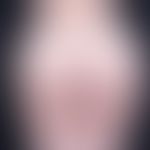 Lipomatose benige symmetrische, gynäkoider Typ: unproportionale Verteilung des Fettgewebes mit Ve...
