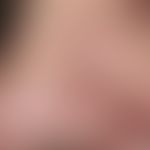 Dermal melanocytic nevus: melanocyticnevus known since earliest childhood, initially dark brown, ...
