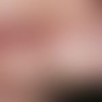 Nasal papule, fibrous, solitary, seti-year-old, 0.5 cm diameter, sharply defined, symptom-free, s...