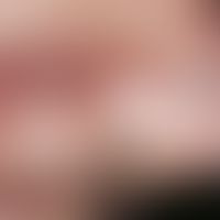 Nasal papule, fibrous, solitary, seti-year-old, 0.5 cm diameter, sharply defined, symptom-free, s...