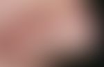 Nasenpapel, fibröse:&nbsp;solitäre, seti Jahren bestehende, 0,5 cm durchmessende, scharf begrenzt...