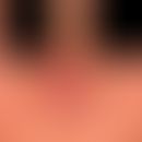 Rhinophym umschriebenes: seit mehreren Jahren zunehmende, symptomlose,&nbsp;lokalisierte Phymbild...