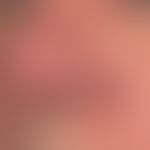 Circumscribed rhinophyma: Symptomless nodular nodules on the left nostril of a 65-year-old man th...