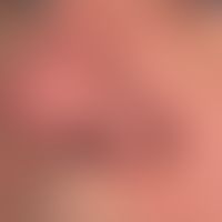 Circumscribed rhinophyma: Symptomless nodular nodules on the left nostril of a 65-year-old man th...