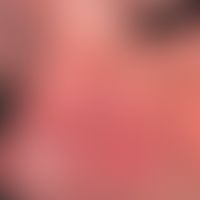 Rhinophyma described: since 2 years increasing, symptomless, localized phymogenesis (border marke...