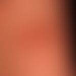 Mastozytom kutanes:&nbsp;nach Reiben, zentrale Basenbildung (durch Pfeile markiert).&nbsp;Durch V...