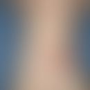 Urticaria pigmentosa des Kindesalters: Seit dem 1. Lebensmonat nachweisbar; in den folgenden Mona...