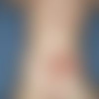 Urticaria pigmentosa des Kindesalters: Seit dem 1. Lebensmonat nachweisbar; in den folgenden Mona...