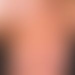 Urticaria pigmentosa (overview): Adult form of Urticaria pigmentosa (erythroderma). With a histor...