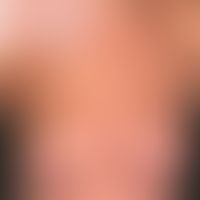 Urticaria pigmentosa (overview): Adult form of Urticaria pigmentosa (erythroderma). With a histor...