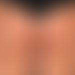 Urticaria pigmentosa: General view: Differently large, disseminated, flat, oval or round, brownis...