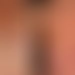 Urticaria pigmentosa (overview): Adult form of Urticaira pigmentosa (erythroderma), with a histor...