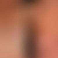 Urticaria pigmentosa (overview): Adult form of Urticaira pigmentosa (erythroderma), with a histor...