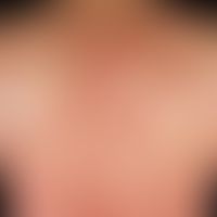 teleangiectasia macularis eruptiva perstans. multiple red spots, telangiectasia and dicreter brow...