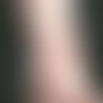 Multiple mastocytomas: disseminated, flat brownish-reddish, itchy, smooth spots and plaques on th...
