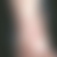Multiple mastocytomas: disseminated, flat brownish-reddish, itchy, smooth spots and plaques on th...
