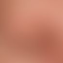 Ulerythema ophryogenes: Flächiges&nbsp;Erythem mit geringer Rarefizierung der &nbsp;Augenbrauen.
