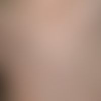 Urticaria pigmentosa des Kindesalters:&nbsp;6 Monate alter Säugling. Hautveränderungen angeboren....