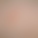 Urticaria pigmentosa des Kindesalters: Detailaufnahme. Bizarr begrenzter&nbsp;gelb-brauner Fleck....