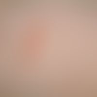 Urticaria pigmentosa des Kindesalters: Detailaufnahme. Bizarr begrenzter&nbsp;gelb-brauner Fleck....