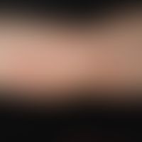 Urticaria pigmentosa des Kindesalters:&nbsp;6 Jahre alter Junge. Seit&nbsp;dem 2. LJ&nbsp;&nbsp;"...