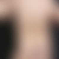 Urticaria pigmentosa des Kindesalters: Disseminierte, 0,2-1,0 cm große, symptomlose, hellbraune F...