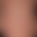 Melanose transiente&nbsp;neonatale pustulöse: disseminierte, hier rumpfbetonte,&nbsp;nicht-sympto...