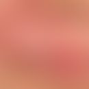 Cheilitis granulomatosa. 3-year-old disease symptoms. solitary, chronically dynamic, initially va...