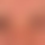 Melkersson-Rosenthal syndrome (monsymptomatic form; here Blepharitis granulomatosa): initially re...