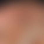 Melanodermatitis toxica. solitary, chronically stationary (no growth dynamics), large-area, blurr...