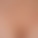 Molluscum contagiosum:&nbsp;disseminierte&nbsp; Mollusca contagiosa;&nbsp;Erstauftreten einige Wo...