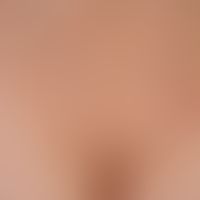 Molluscum contagiosum: disseminated mollusca contagiosa; first appearance a few weeks after child...