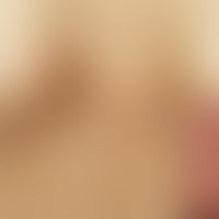 Molluscum contagiosa: multiple, 0.2-0.3 cm large, yellow-reddish, firm, shiny, completely asympto...